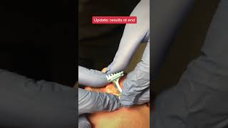 Download lagu How dermatologists remove moles. #shorts mp3 Download lagu How dermatologists remove moles. #shorts mp3