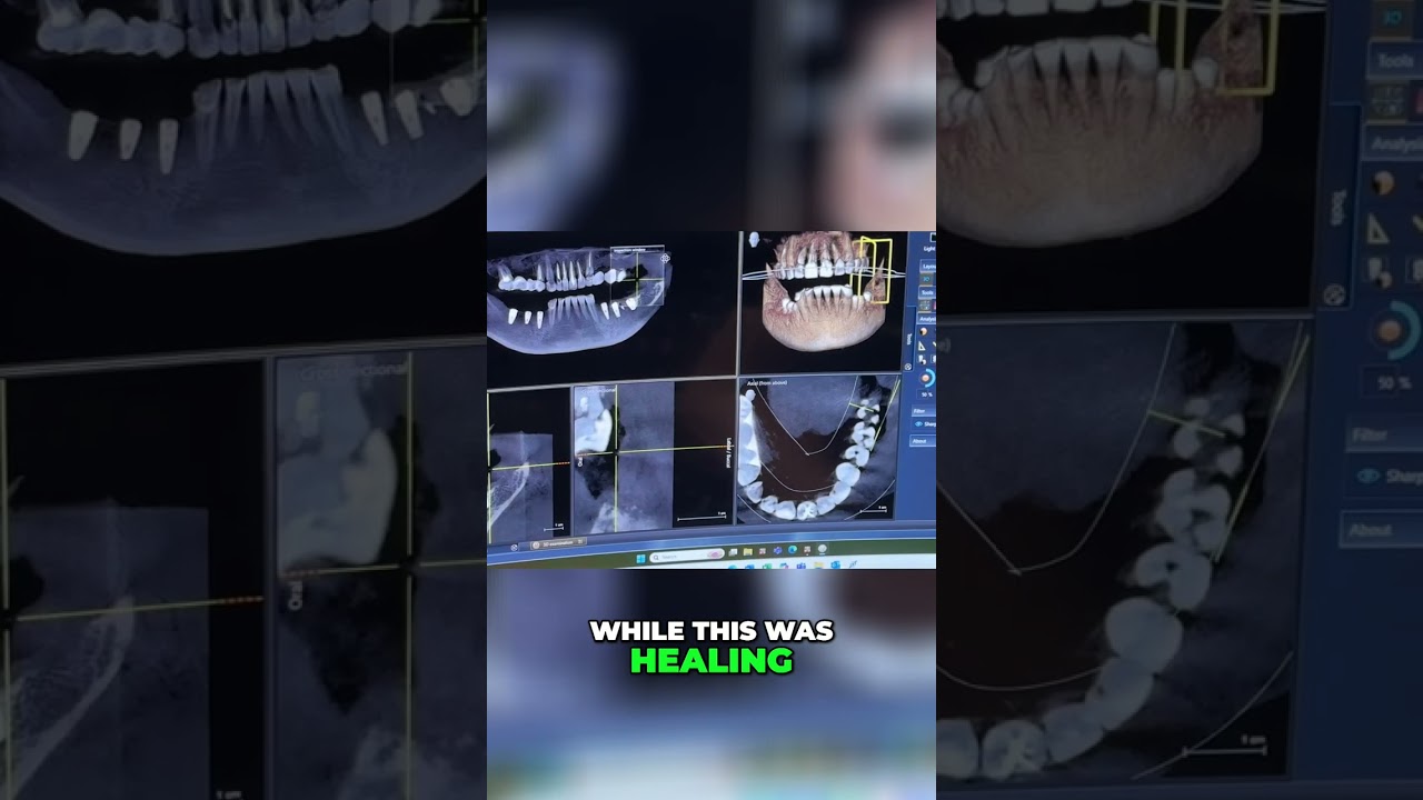 Dental Implants: New Bone Growth Process Explained! #shorts