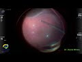 PPV for macula-off rhegmatogenous retinal detachment