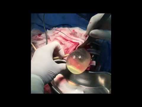 Hydatid Cyst Of The Brain Delivery By Hydrodissection