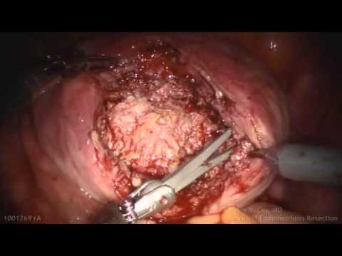 Advanced Robotic Surgery- Uterine Adenomyosis Resection