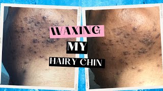 Waxing my under chin hair for the first time | dark under chin | ingrown hair
