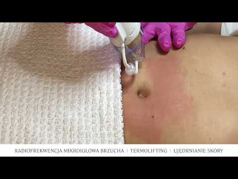 Termolifting brzucha | Radiofrekwencja mikroigłowa - La Source medycyna estetyczna, Poznań