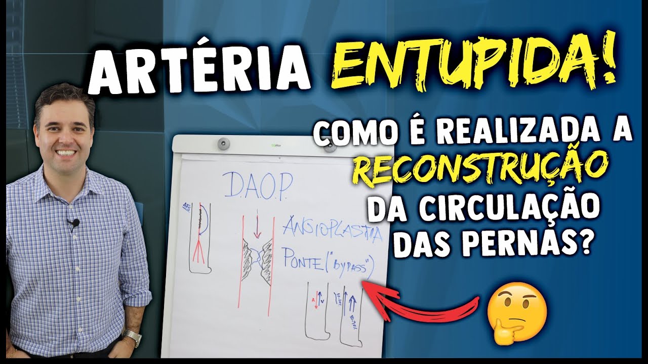 Watch Now ARTÉRIA ENTUPIDA | COMO É REALIZADA A RECONSTRUÇÃO DA CIRCULAÇÃO DAS PERNAS ARTÉRIA ENTUPIDA | COMO É REALIZADA A RECONSTRUÇÃO DA CIRCULAÇÃO DAS PERNAS