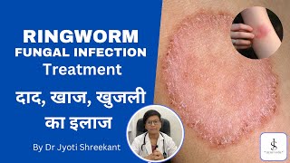 Fungal infection kya hota hai | fungal infection kaise hota hai | Ringworm treatment in hindi