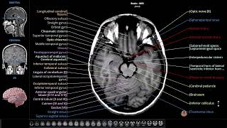 Brain Anatomy on a Magnetic Resonance Imaging (MRI) - Labeled