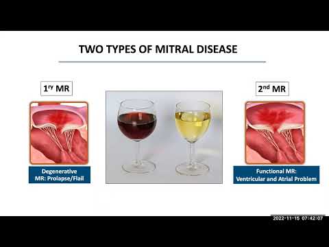 Update in Transcatheter Mitral Valve Interventions