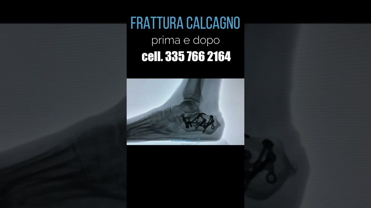 Frattura calcagno prima e dopo | Dott. Andrea Scala | #shorts
