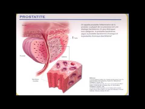 Prostatitis abacteriana cura