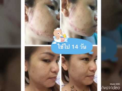 วิธีการชงรากขิงเพื่อเพิ่มความแข็งแรง เชื้อโรคหญิงในร้านขายยาอัลมาตี