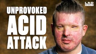 A Stranger Threw Acid in My Face | Minutes With