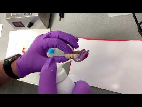 Unterfütterung einer Teleskopprothese