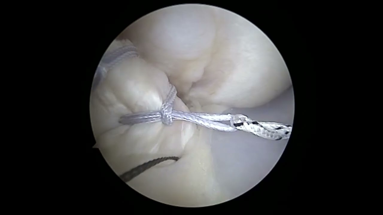 ACL Repair 2025 Update