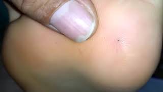 Ingrown Hair Removal Clipja Com