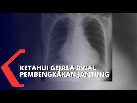 Cara Awal Mendeteksi Pembengkakan Jantung