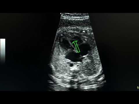 ultrasound of normal fetal heart anatomy in a 33 weeks fetus