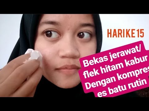 download lagu mp3 mp4 Cara Menghilangkan Bekas Jerawat Dengan Es Batu Berapa Lama, download lagu Cara Menghilangkan Bekas Jerawat Dengan Es Batu Berapa Lama gratis, unduh video klip Cara Menghilangkan Bekas Jerawat Dengan Es Batu Berapa Lama