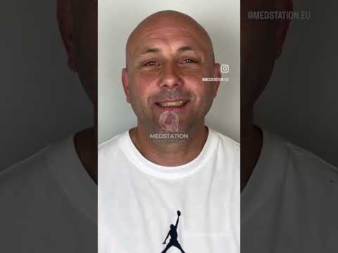 Experience an Incredible Smile Makeover with 24 Zirconium Crowns in Izmir, Turkey