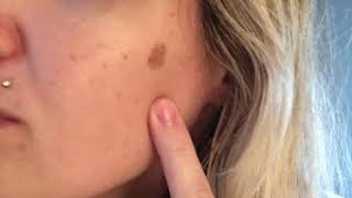 Compound W for Age Spot Removal