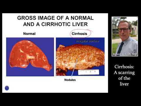 CIRRHOSIS (LIVER SCARRING) by Dr. Robert Gish