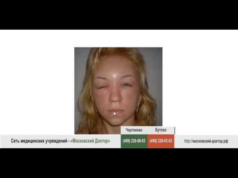 От суставов мед лимон Межпозвонковые диски шейного отдела позвоночника