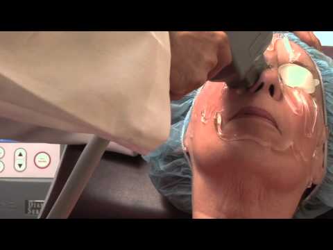 New Intense Pulsed Light Therapy for Chronic Dry Eye - Mayo Clinic