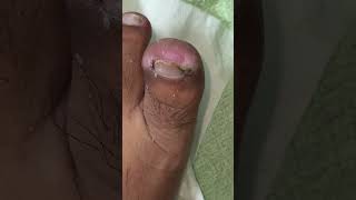 Ep_8749 Ingrown toenail removal 👣 บ้านผม..เป็นเล็บขบทั้งตระกูลครับ 😅 (clip from Thailand)