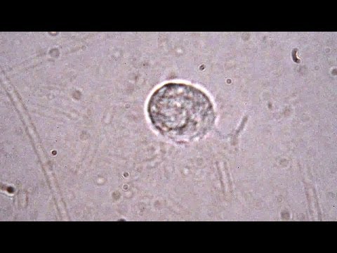 Chlorhexidin bei der Behandlung von Prostatitis Die Auswirkungen der Prostata Laser