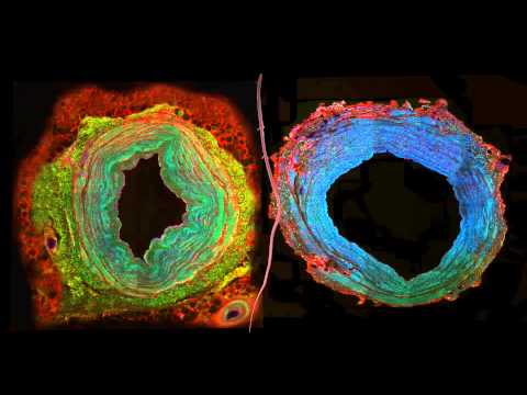 The Great Saphenous Vein and Coronary Bypass Surgery: Effectively Visualising 3D Molecular Data