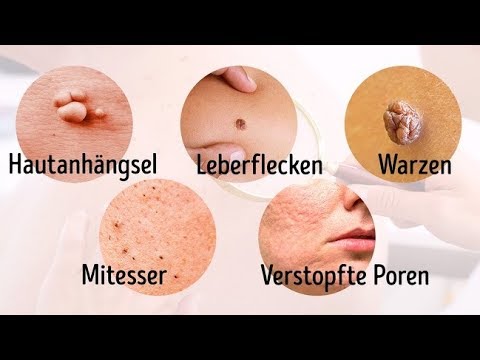 papilloma vírus, személyes edzőm ahol a minőségi papillómákat eltávolítják