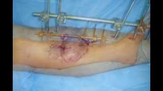 preview picture of video 'Gastrocnemius mascle flap for  proximal tibial fractrure'