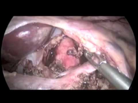 Experience With Laparoscopic Median Arcuate Ligament Release In 26 Patients