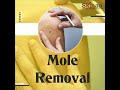 Best Mole Removal Treatment | Viral #shorts