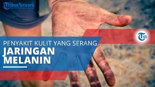 Melanoma, Kanker Kulit yang Ditandai Munculnya Tahi Lalat Baru yang Kemudian Menyebar di Kulit