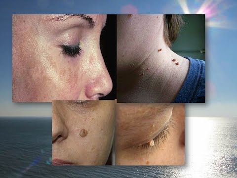 Эффективное удаление пигментных пятен Весны доброй как веснушки
