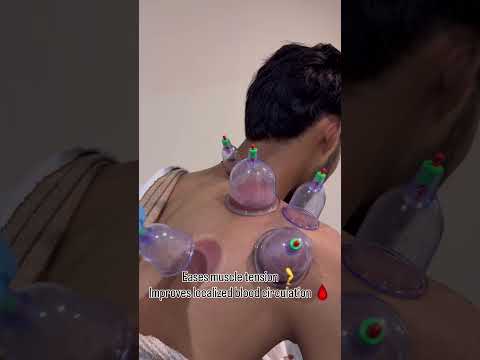 Thumbnail for video: Dry Cupping Therapy Explained