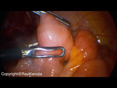 Laparoscopic Retrieval of Endoscopy Capsule