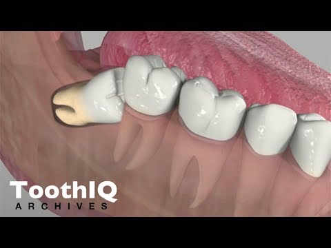 3rd YouTube video about how much can a cavity grow in a month