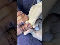 Satisfying Ingrown Toenail Ex 01 XUYEN CA MAU Nail Nailart Nail2023