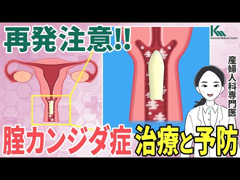 再発性カンジダ症 – その原因と治療方法