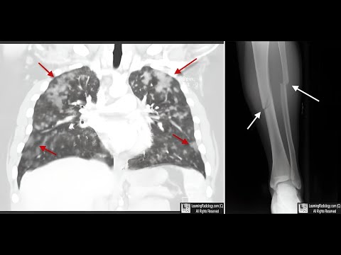 Understanding Fat Embolism Syndrome  A Comprehensive Guide for Orthopedic Surgeons.