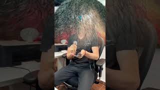 El mejor tratamiento para alopecia androgenética en mujeres y hombres comprobado dermatólogo militar