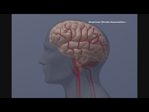 Here are warning signs to monitor for a possible stroke