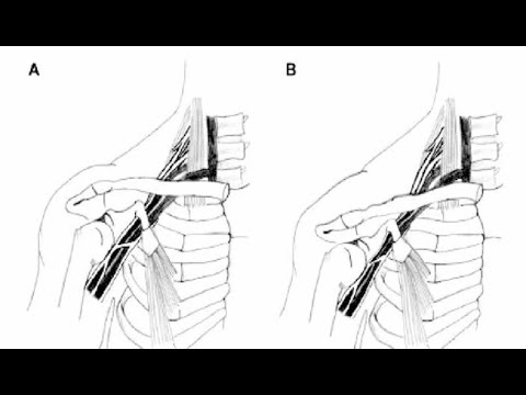 The most important corrective for TOS & chronic neck- and shoulder pain | CCS decompression