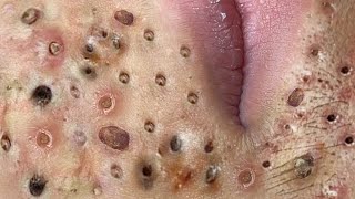 Loan Nguyen Acne Treatment 28n