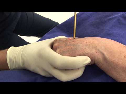 Altersflecken-Entfernung mit gütegeschaltetem Rubin-Laser