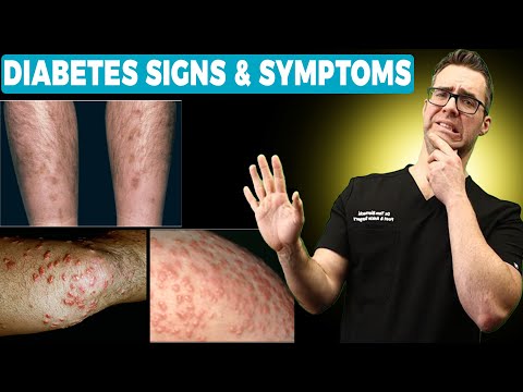 28 Diabetes Signs & Symptoms [REVERSE DIABETES + 2 BIG SECRETS!]