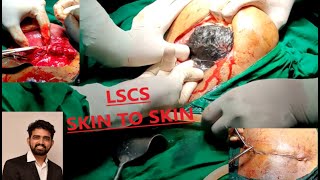 CESAREAN SECTION (SKIN TO SKIN) IN A PATIENT WITH PREVIOUS  LSCS WITH VOICE OVER.