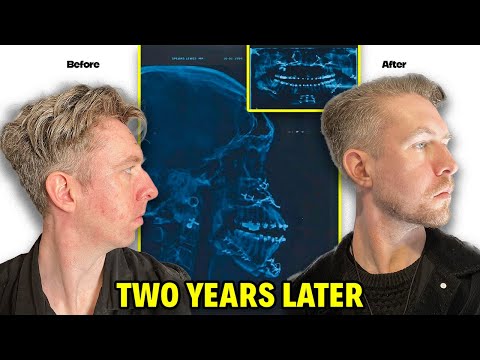 I Had Double Jaw Surgery. Here's What They DON'T Tell You.