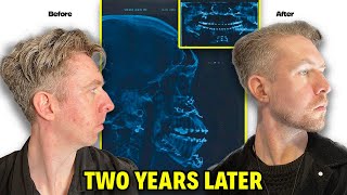 I Had Double Jaw Surgery. Here's What They DON'T Tell You.
